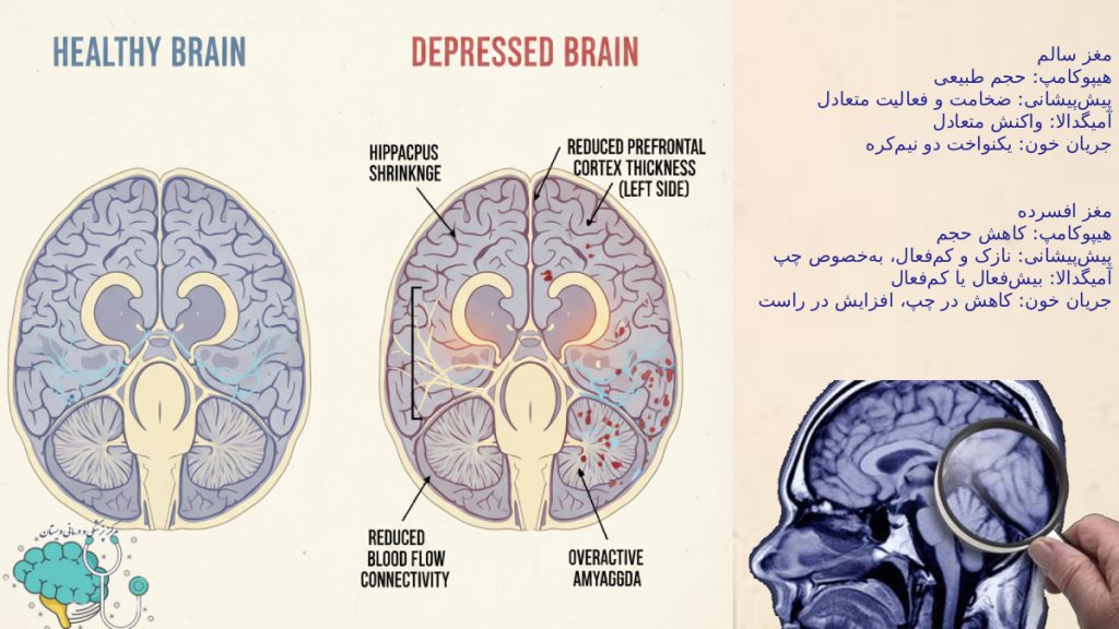 عکس مغز سالم و مغز افسرده در اسکن همراه ویژگی های مغز سالم و مغز افسرده که به شکل متن در تصویر نوشته شده