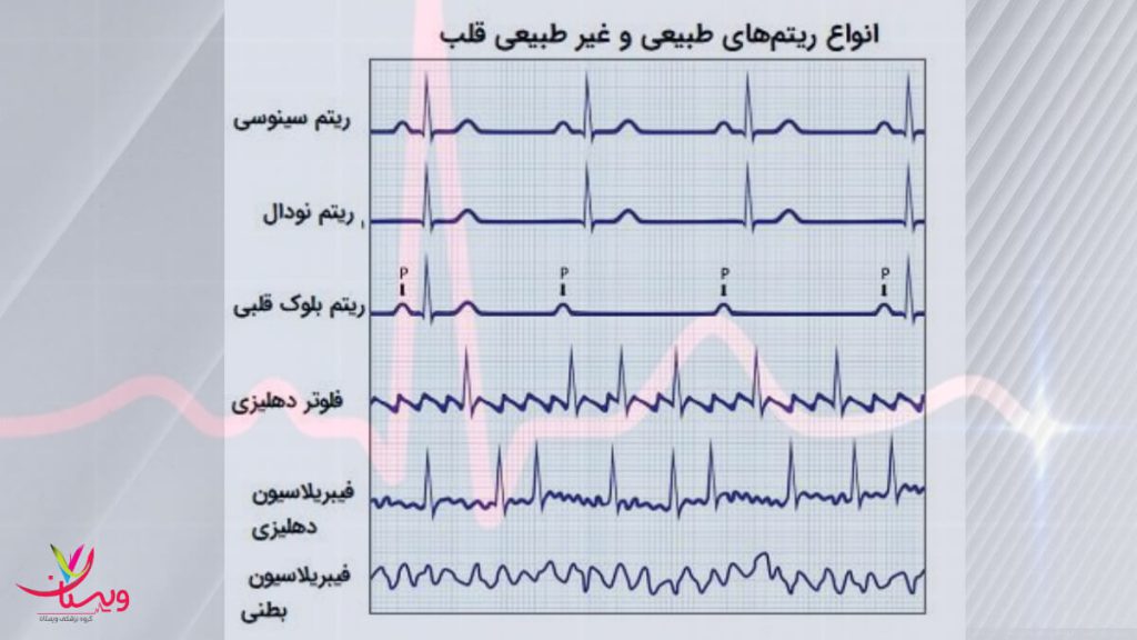 انواع ریتم قلبی 
