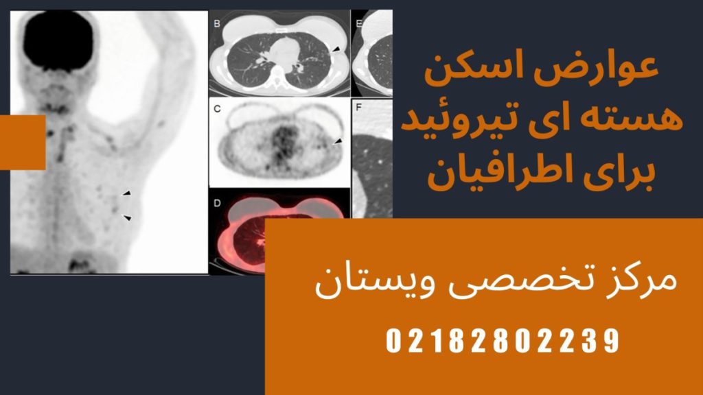 نتیجه اسکن هسته ای تیروئید