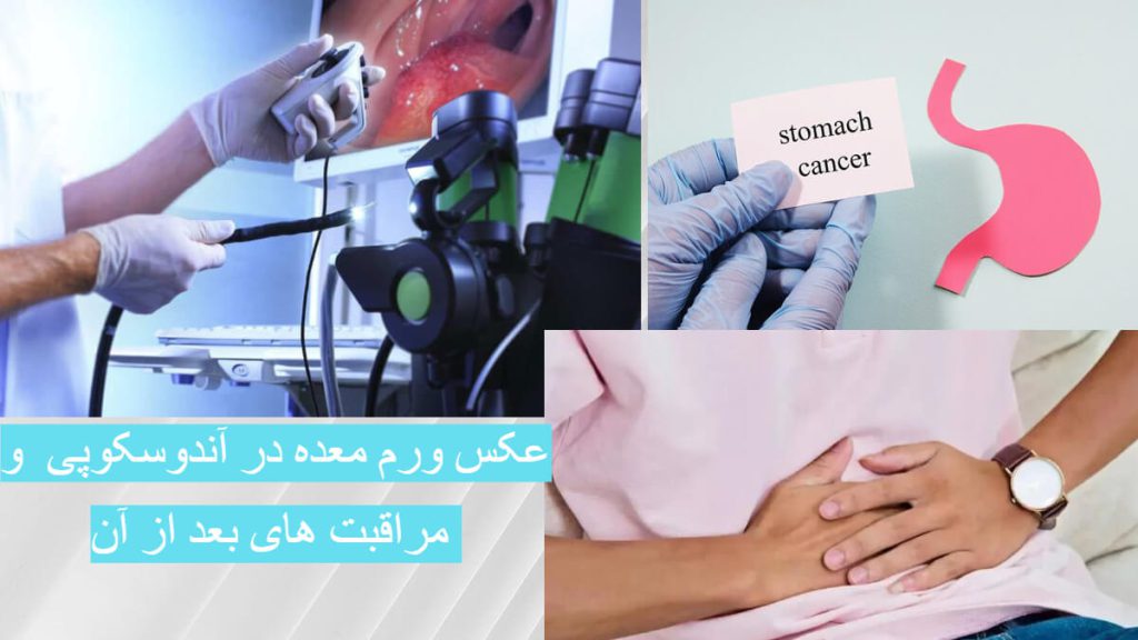 عکس ورم معده در آندوسکوپی