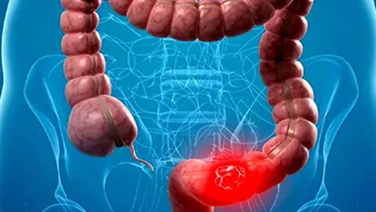 فرق علائم IBS و IBD چیست؟ فرق علائم IBS و IBD چیست؟