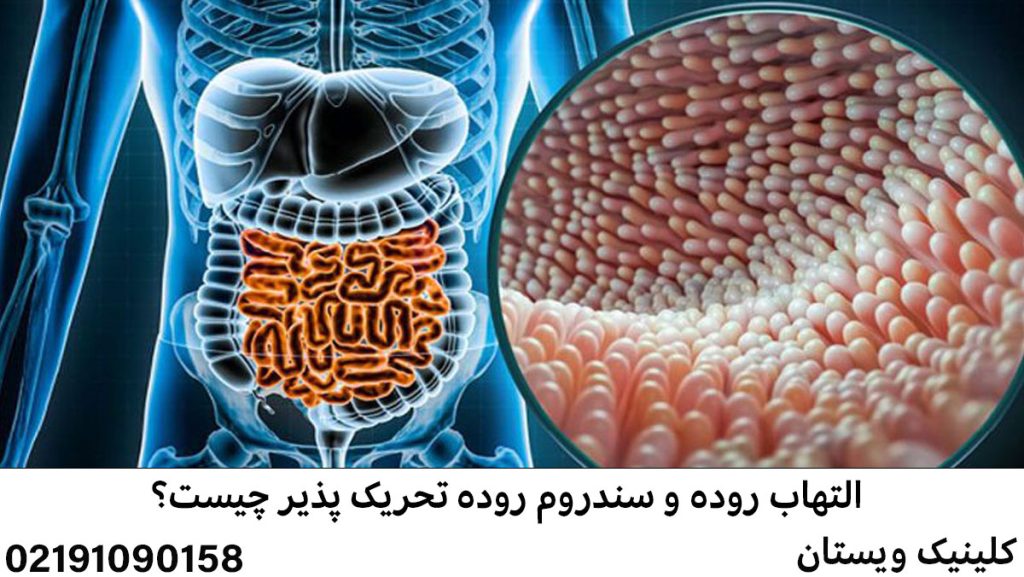 تفاوت التهاب روده (IBD) با سندرم روده تحریکپذیر (IBS)