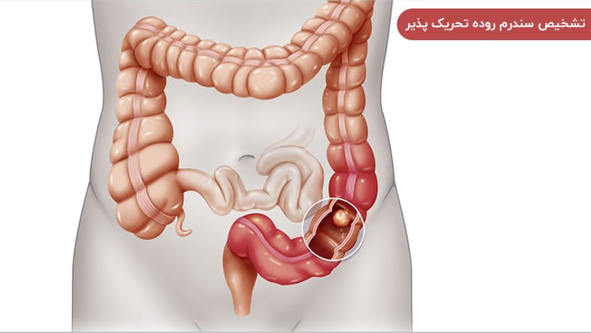 چگونه پزشک سندروم روده تحریک پذیر IBS را تشخیص میدهد؟ چگونه پزشک سندروم روده تحریک پذیر IBS را تشخیص میدهد؟