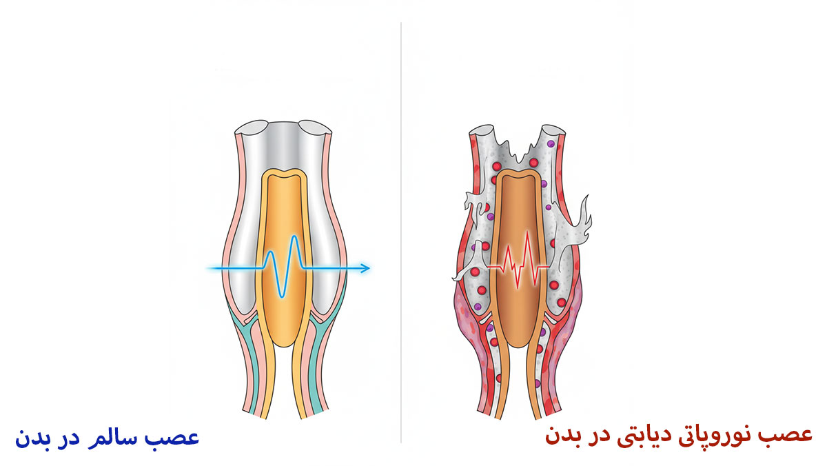 مقایسه عصب سالم در بدن و عصب نوروپاتی دیابتی در بدن مقایسه عصب سالم در بدن و عصب نوروپاتی دیابتی در بدن