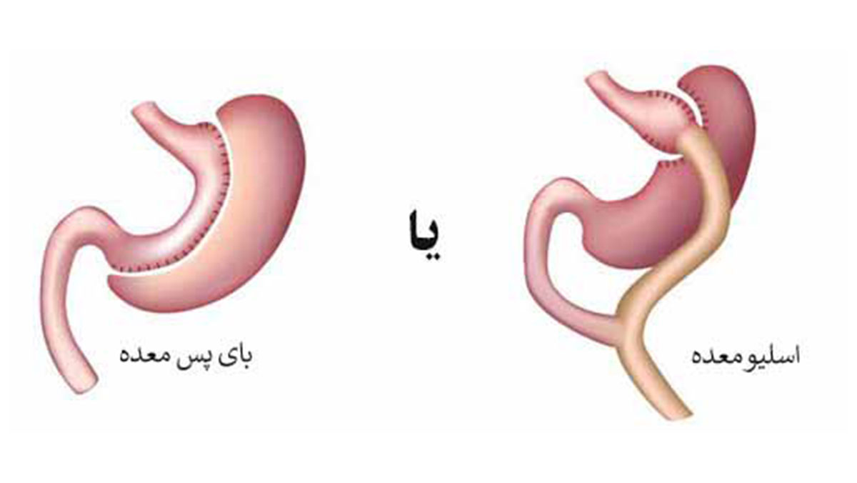 اسلیو معده بهتر است یا بای پس؟ اسلیو معده بهتر است یا بای پس؟