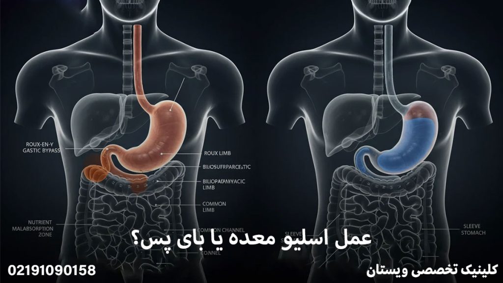 اسلیو معده یا بای پس؟ مقایسه تخصصی و انتخاب بهترین عمل 1405