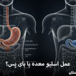 اسلیو معده یا بای پس؟ مقایسه تخصصی و انتخاب بهترین عمل 1405