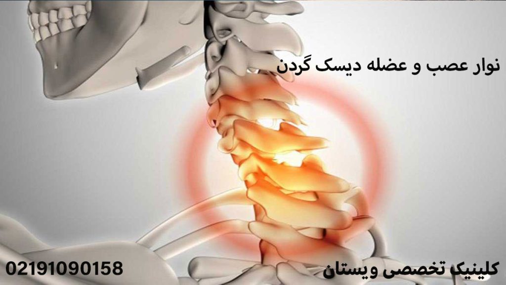 نوار عصب و عضله دیسک گردن
