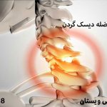 نوار عصب و عضله دیسک گردن