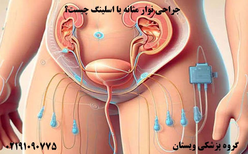 جراحی نوار مثانه (اسلینگ/TVT/TOT)