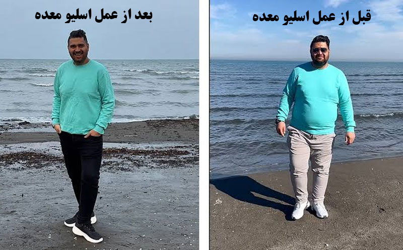 عکس واقعی قبل و بعد از عمل اسلیو معده + کاهش وزن ایده آل عکس واقعی قبل و بعد از عمل اسلیو معده + کاهش وزن ایده آل