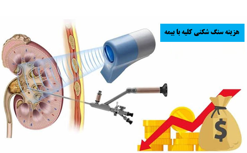 هزینه سنگ شکنی کلیه با بیمه تامین اجتماعی و تکمیلی هزینه سنگ شکنی کلیه با بیمه تامین اجتماعی و تکمیلی