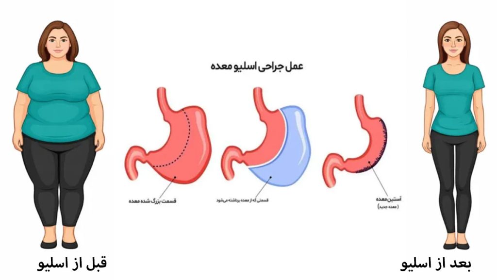 عکس قبل و بعد از عمل اسلیو معده عکس قبل و بعد از عمل اسلیو معده