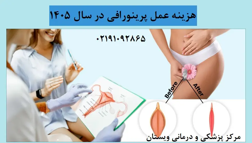هزینه عمل پرینورافی در سال 1405 چقدر است؟ + عوامل موثر بر هزینه